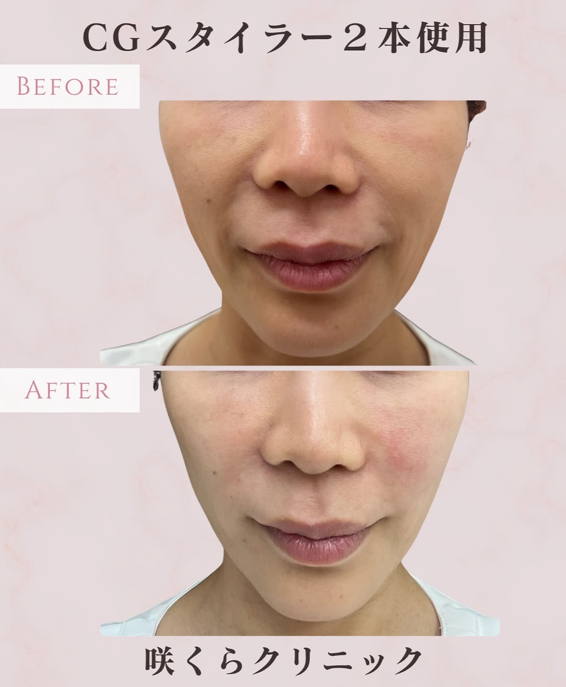 ペプチド配合ヒアルロン酸“CGスタイラー”でほうれい線の改善 | 咲くら